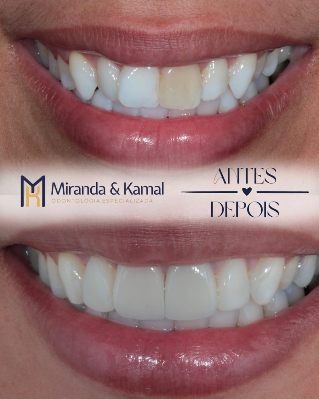 Antes e depois: Reabilitação estética