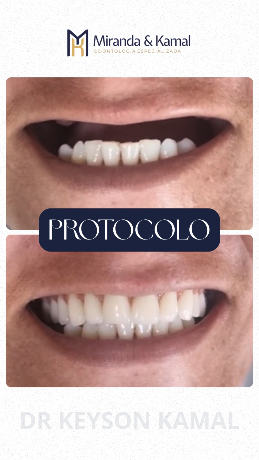 Antes e depois: Protocolo sobre implantes