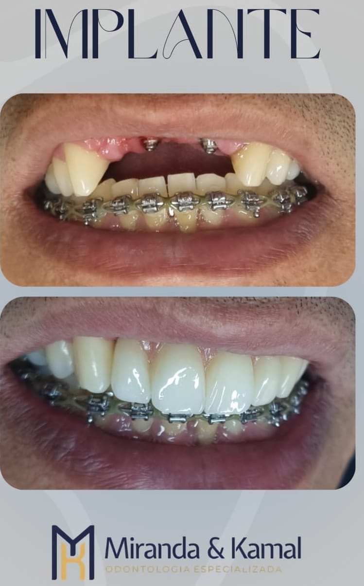 Antes e depois: Implantes unitários